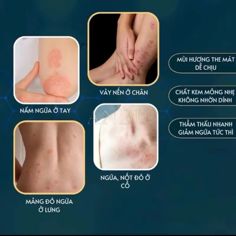 Kem Bôi Da Liễu Nhật Bản cho da mỏng da nhạy cảm - Hiểu Quả Cao 1