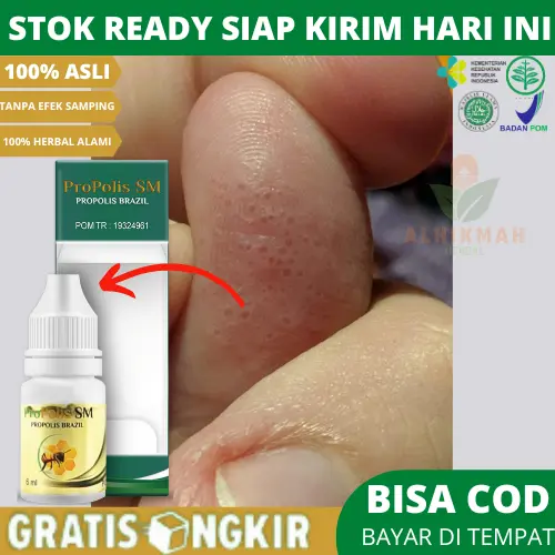 Oles Gatal Berair Di Jari Tangan / Ujung Jari, Gatal Dishidrosis, Bintik Air, Gatal Kutu Air, ALergi Deterjen, Dermatitis Kontak - Propolis sm