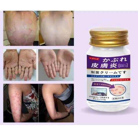 Cao Bôi Giảm Nấm Ngứa Nasuka Viêm Da Cơ Địa - Nguyên Liệu Nhật Bản - Chăm Sóc Da Hiệu Quả 1
