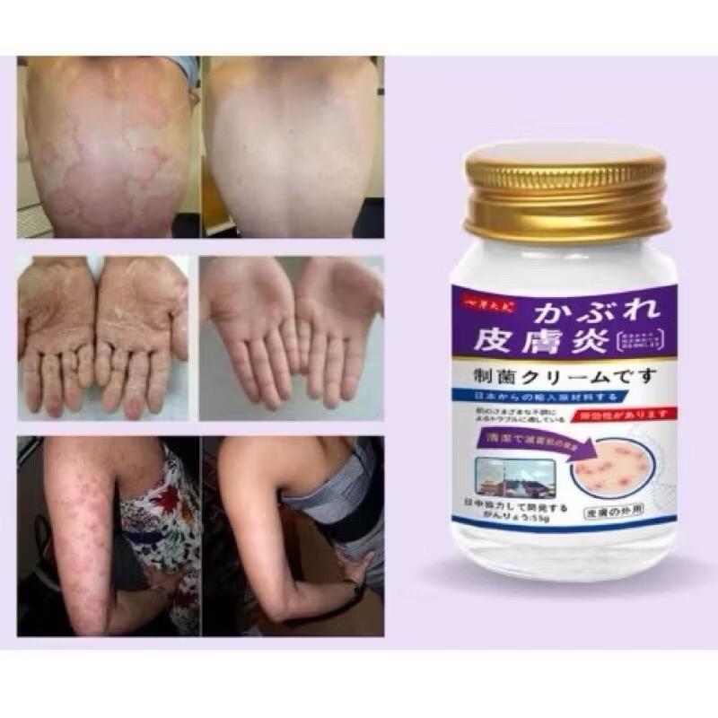 Cao Bôi Nấm Ngứa Nasuka  Viêm Da Cơ Địa - Nguyên Liệu Nhật Bản - Hiệu Quả Tức Thì 6