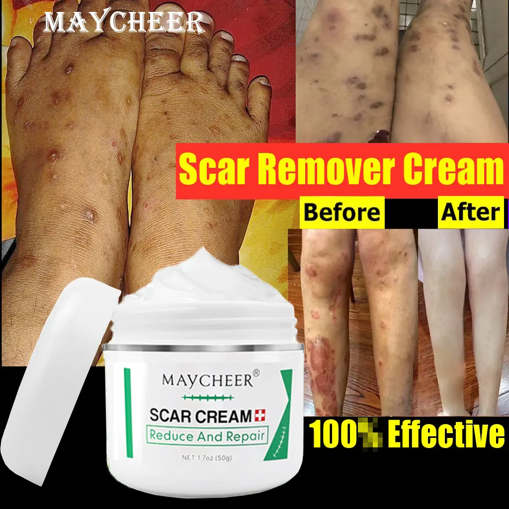 【MAYCHEER】Acne Scar Remover Old Scar Scarminator Cream Strech Mark Remover Scar Removal Pimple Mark Remover