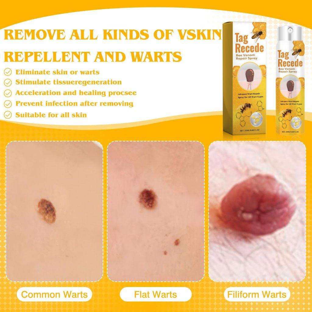 Penghilang Kutil Dan Tahi Lalat Obat Penghilang Kutil Penghilang Tahi Lalat Di Wajah Obat Kutil Ampuh Skin Tag Remover [S09]