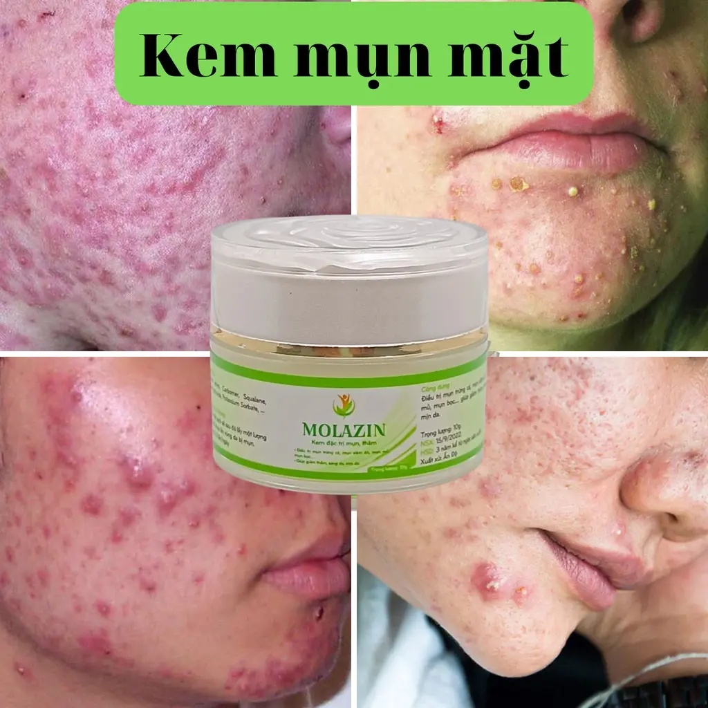 Kem mụn Ẩn mụn Viêm Đỏ mụn Bọc mụn đầu đen dành cho mặt MOLAZIN an toàn K0 để lại SẸO, THÂM sau khi hết mụn....Ấn Độ