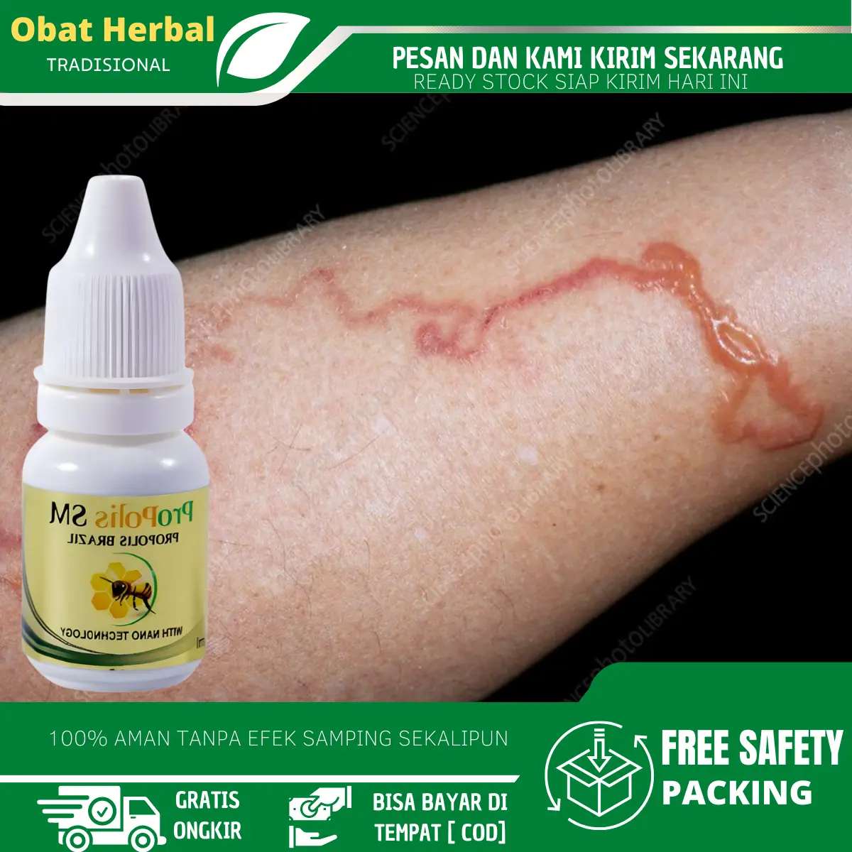 Cairan Oles Penghilang Cacing Pasir di Kulit, Infeksi Cacing Tambang, Cutaneous Larva Migrans Dengan Propolis sm