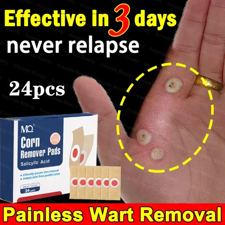 24PCS CORN REMOVAL PATCH - Koyo Kaki Ampuh Plester Penghilang Kutil Kapalan Mata Ikan Kapalan Corn Patch Removal Obat Kutil Kapalan Mata Ikan Kaki/Plester Penghilang Kutil Mata Ikan 2