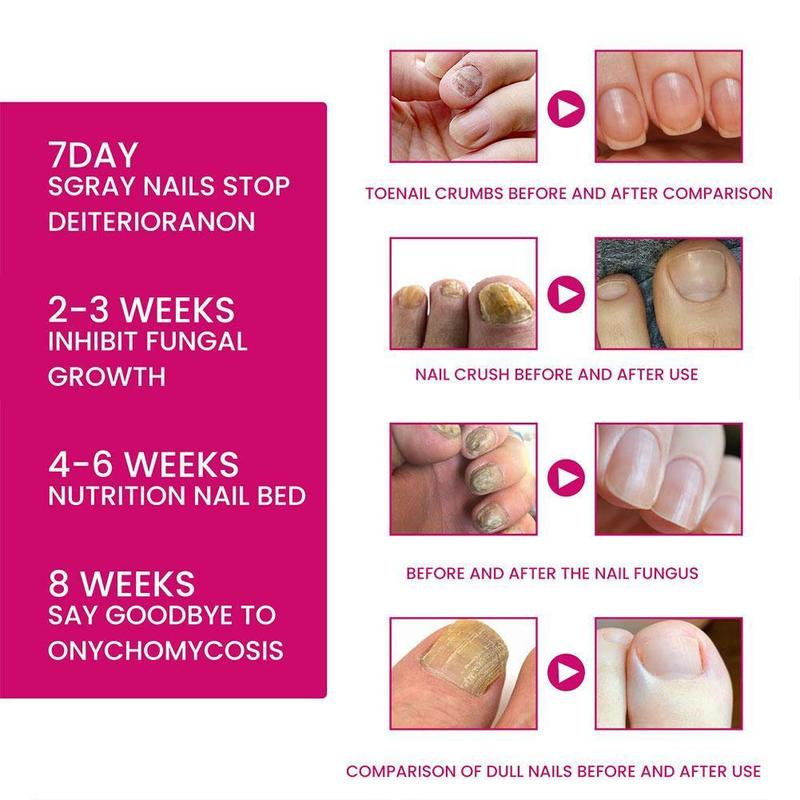 Product Introduction of Serum dưỡng móng Tinh chất phục hồi móng Serum Nấm móng Onychomycosis Chăm sóc bàn chân Nuôi dưỡng móng B6E9 30