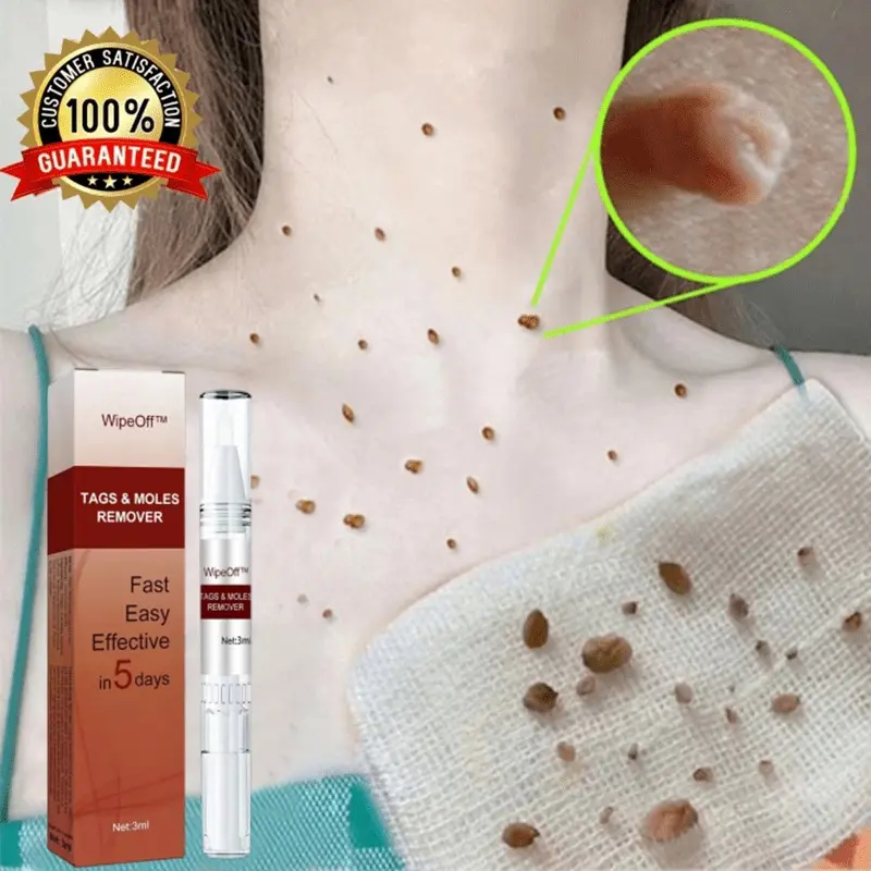 Penghilang kutil Wart Remover Pen Penghilang Kutil Dan Tahi Lalat