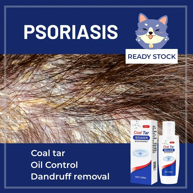 psoriasis shampoo coal tar shampoo anti dandruff shampoo dandruff treatment shampoo dandruff medicine scalp medicine Anti itching Refreshing Scalp Oil Control