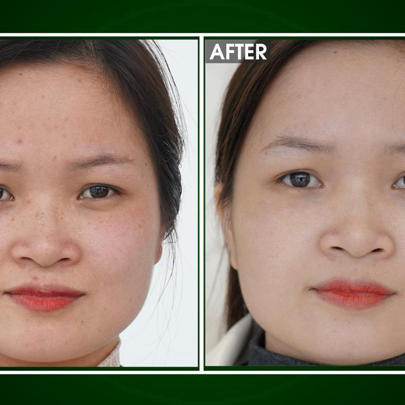 TÁI TẠO DA X10 Linh Hương ( Date 3 Năm hàng ch/hãng) 4