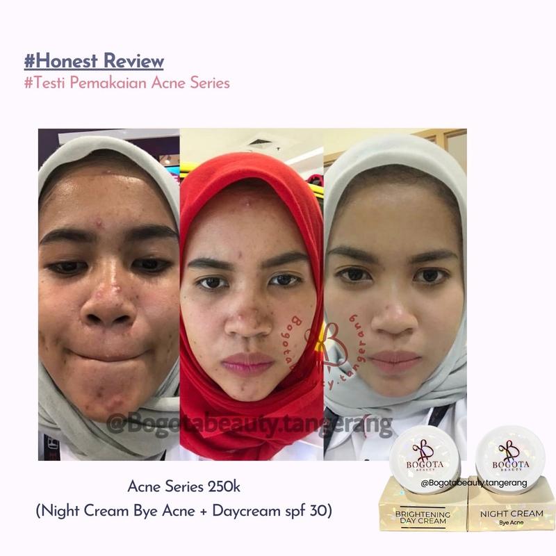 Bogota Beauty Skincare Bogota Normal Series Bogota Acne Series by Bogota Beauty Semua Jenis Kulit 2