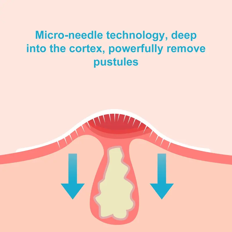 Microneedle Acne Patches, 18/36pcs/box Advanced Acne Technology Patches, Soothing & Soft Skin, Suitable for All Skin Prone To Acne 3