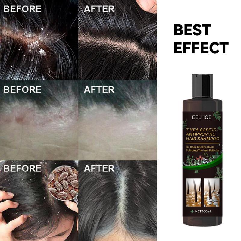 Product Introduction of Antipruritic Hair Shampoo Treat Psoriatic Seborrheic Dermatitis Anti Dandruff Oil Control Damage Repair 6