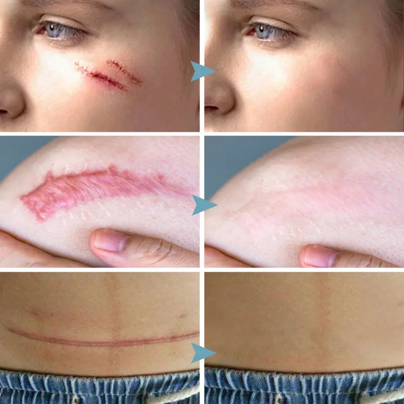 Salep Penghilang Bekas Luka Susu Tubuh Penghilang Bekas Luka Koreng Hitam Penghilang Bekas Luka Gigitan Nyamuk, Stretch Mark, Penghilang Bekas Luka Jahitan 5