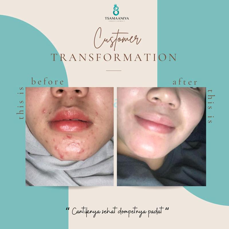 Tsamaaniya paket acne basic (untuk jerawat aktif) 3