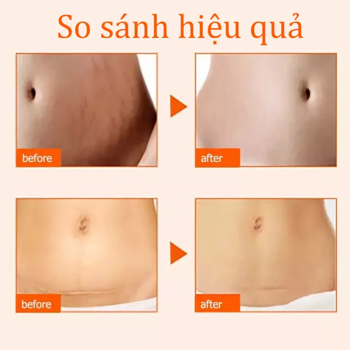 Dầu chăm rạn và làm mờ sẹo Bio-Oil 200ml 3