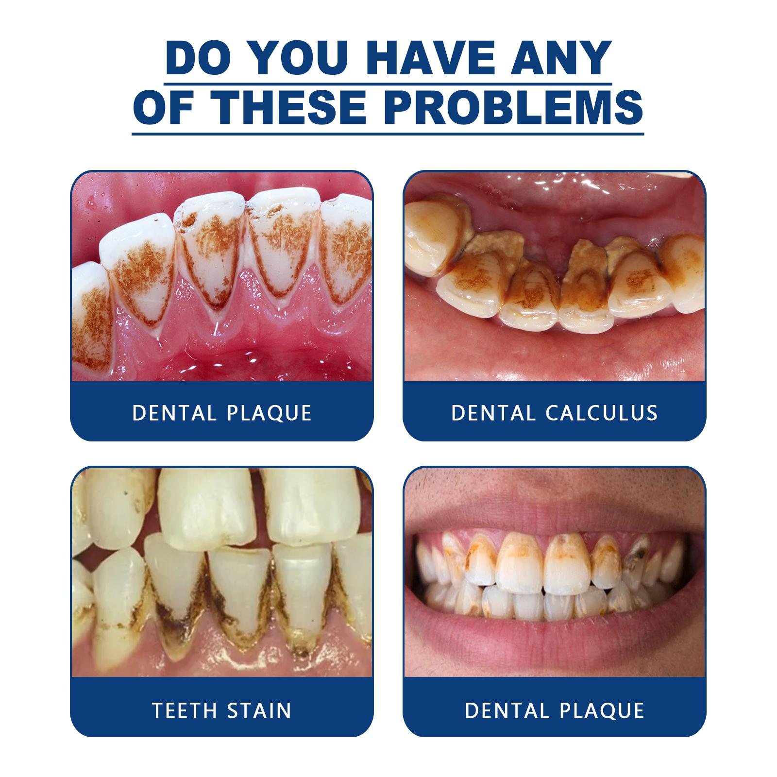 Penghilang Tartar Kecantikan Penghilang Tartar Keras 30ml Alat Pembersih Tartar Pemutih Gigi Penghilang Tartar Kuning Penghilang Tartar Permanen Efektif Pemutih Gigi Menghilangkan plak gigi dan noda asap menghilangkan bau mulut [C10]