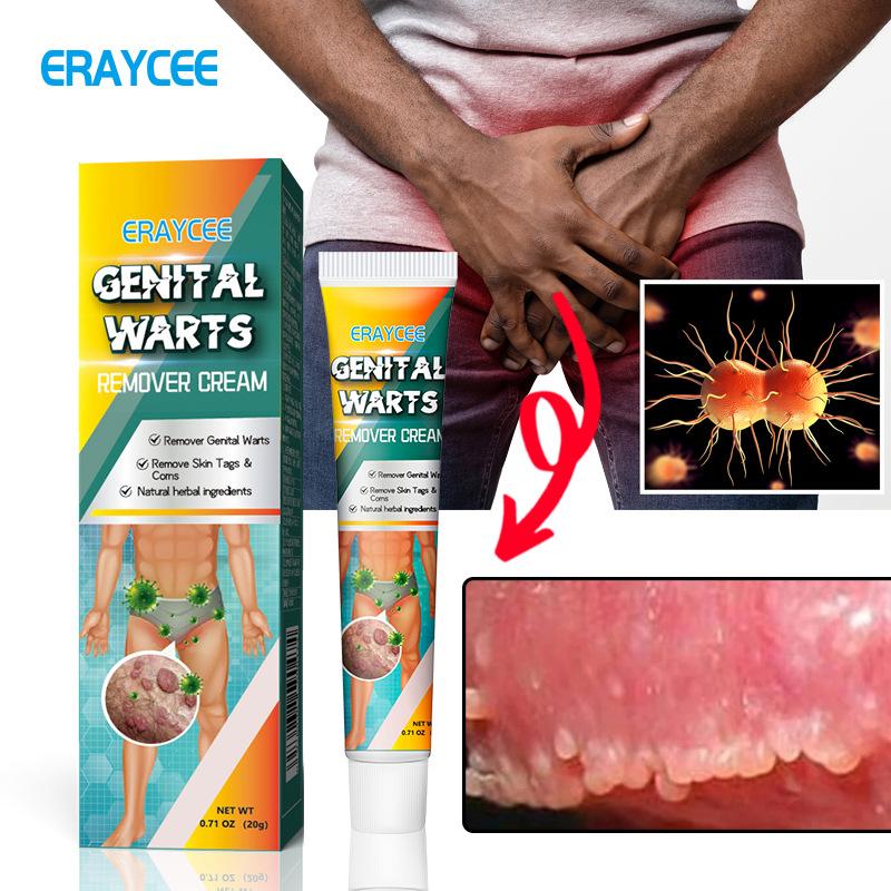 Product Introduction of Kem Loại Bỏ Mụn Cóc Thảo Dược, Dành Cho Nam Và Nữ, Sử Dụng Trên Khu Vực Riêng Tư, Pinghou You, Hiệu Quả 4