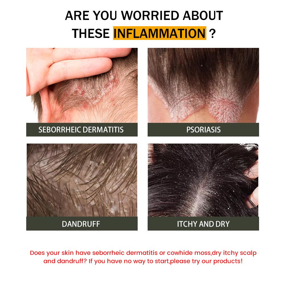 Obat Psoriasis di Kepala, Kulit Kepala Kering, Ketombe Parah, Kulit Kepala Gatal, Jamur Kulit Kepala, Ulkus di Kepala, Dermatitis Seboroik, Ulkus Kepala yang Berdarah, Kulit Kepala Bau, Budug di Kepala, Kurap di Kepala