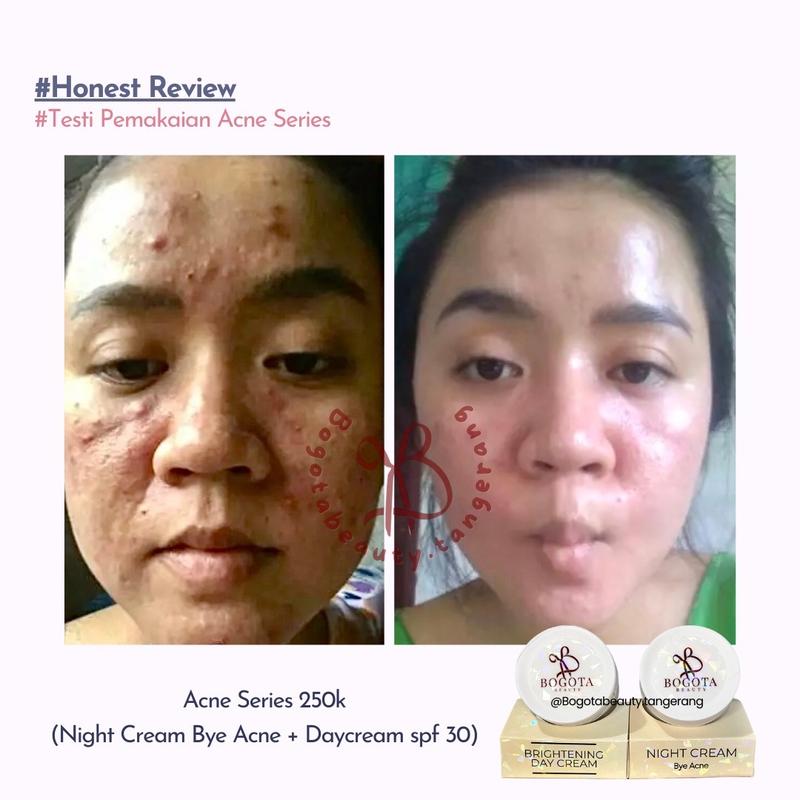 Bogota Beauty Skincare Bogota Normal Series Bogota Acne Series by Bogota Beauty Semua Jenis Kulit 1