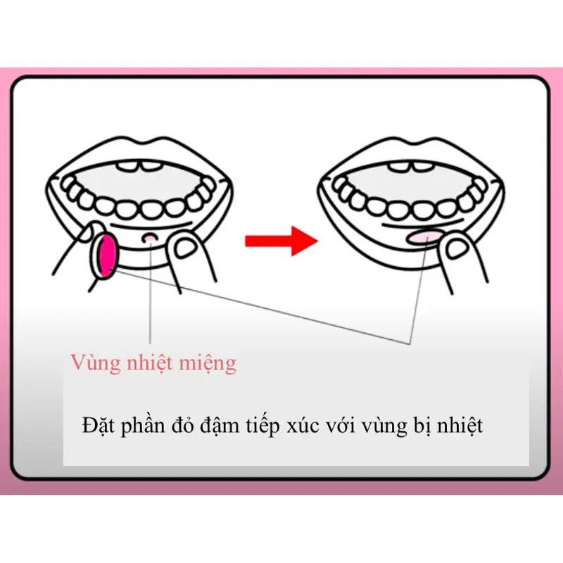 Miếng dán và kem gel bôi nhiệt miệng Taisho Nhật Bản giảm nhiệt miêng, lở miệng, loét miệng 3