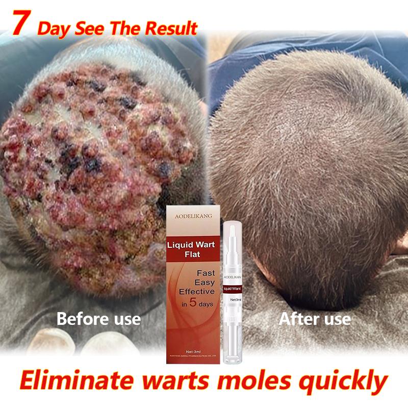 Product Introduction of Warts Remover Cream Original Watson Warts Removal Mole Remover Organic Cream Skin Tags and Warts Remover Original 1