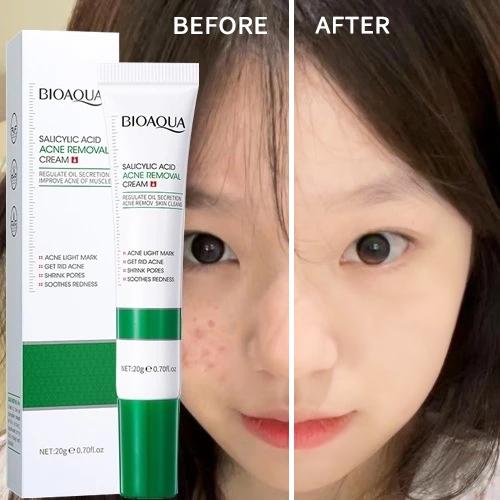 Kem loại bỏ mụn axit salicylic nhanh chóng loại bỏ mụn bọc Giảm Mụn Đầu Đen Và Mụn Trứng Cá 20g 0