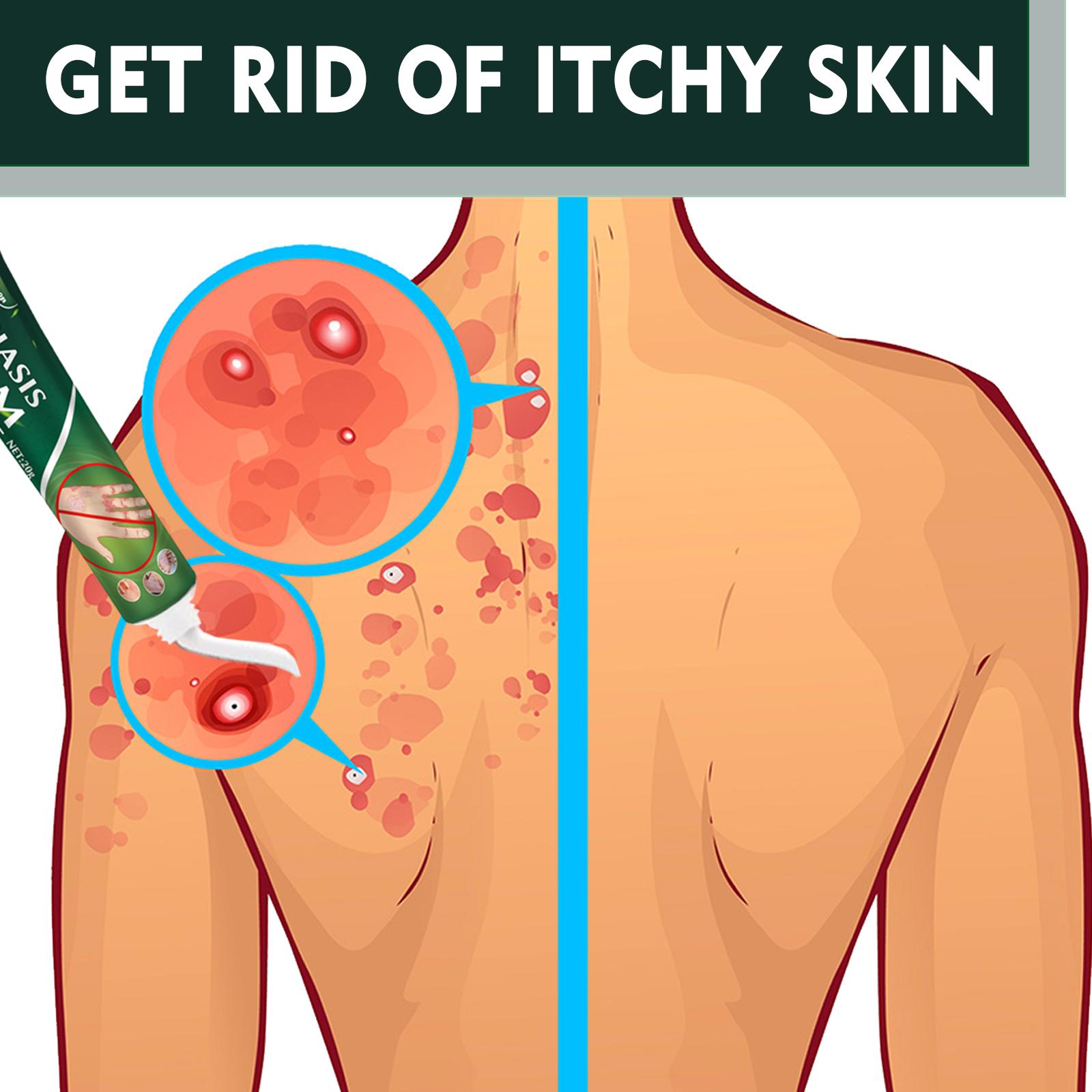 Salep Psoriasis Anti-Gatal Paling Efektif Salep Gatal Cina 0 Obat Gatal Selangkangan Paling Efektif Salep Eksim Kering 20g Salep Gatal Selangkangan 0 Obat Gatal Genital Obat Gatal Kulit Perbaikan Kulit Salep Psoriasis Anti-Gatal Paling Efektif Salep Gatal Cina 0 Obat Gatal Selangkangan Paling Efektif Salep Eksim Kering 20g Salep Gatal Selangkangan 0 Obat Gatal Genital Obat Gatal Kulit Perbaikan Kulit