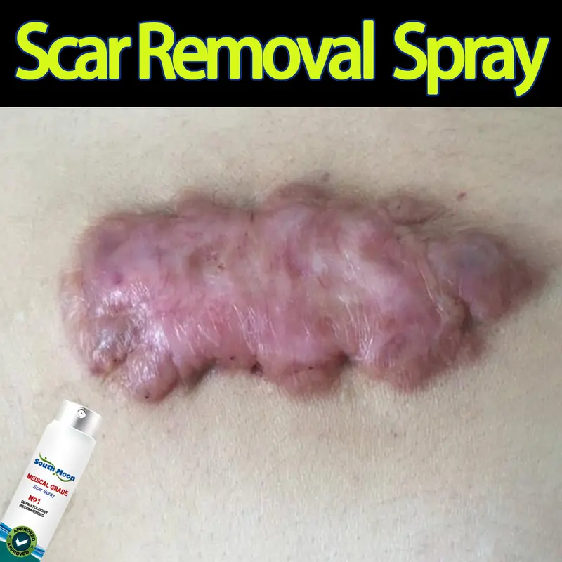 semprotan penghilang bekas luka scar remover spray removal repair skin care Acne Treatment Perawatan jerawat remove stretch marks Repair Burn Surgical Scar 0