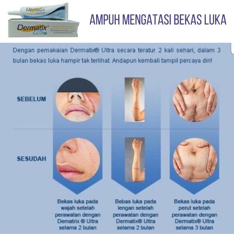Product Introduction of COD Dermatix dermatix penghilang bekas luka  Apotik  15gel Krim Penghilang Bekas Luka Origina 1