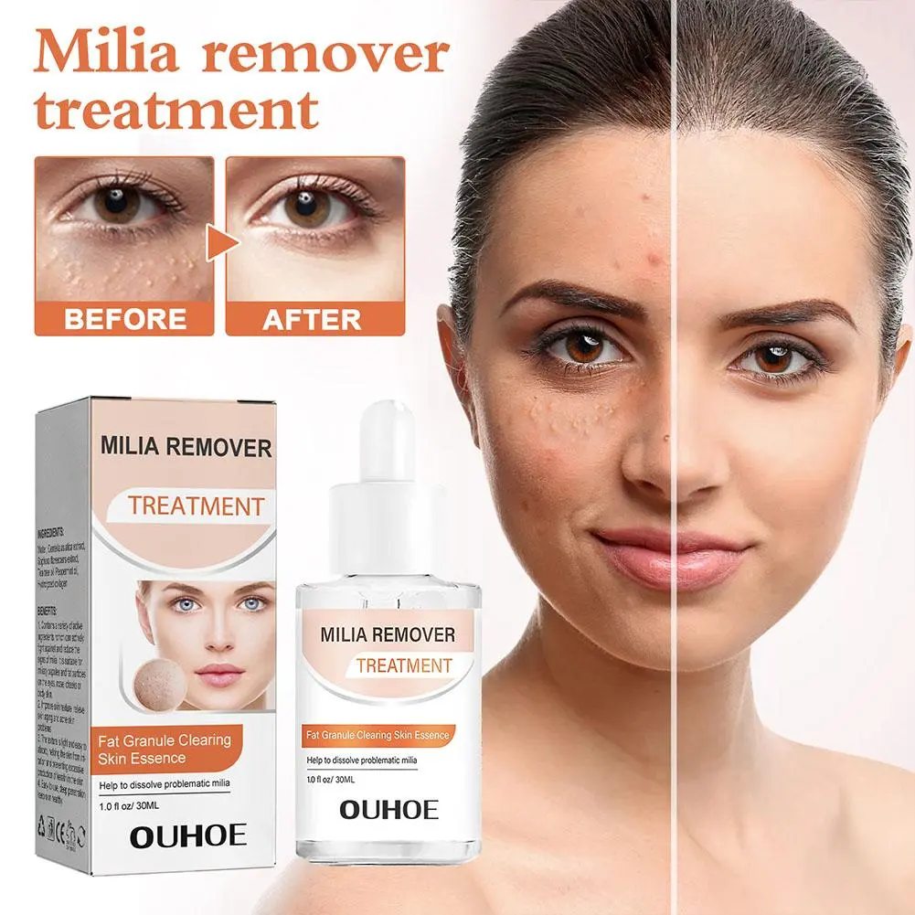 30ml Milia Remover Essence Fat Granule Repair Serum Care Acne Serum Skin