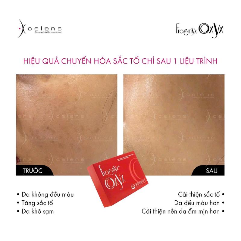 Meso FragmyX Oxyx Tinh Chất Hỗ Trợ Làm Sáng Da Dưỡng Ẩm Da Serum Nữ Skincare 4
