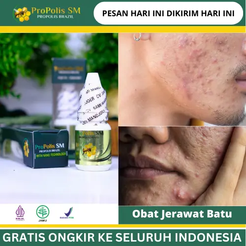 Jerawat bengkak, Perawatan Kulit Berjerawat, Jerawat Batu, Jerawat Milia, Jerawat bernanah, Bekas Jerawat, Mengatasi bopeng bekas Jerawat, Jerawatan Pria & Wanita Dengan Propolis Sm