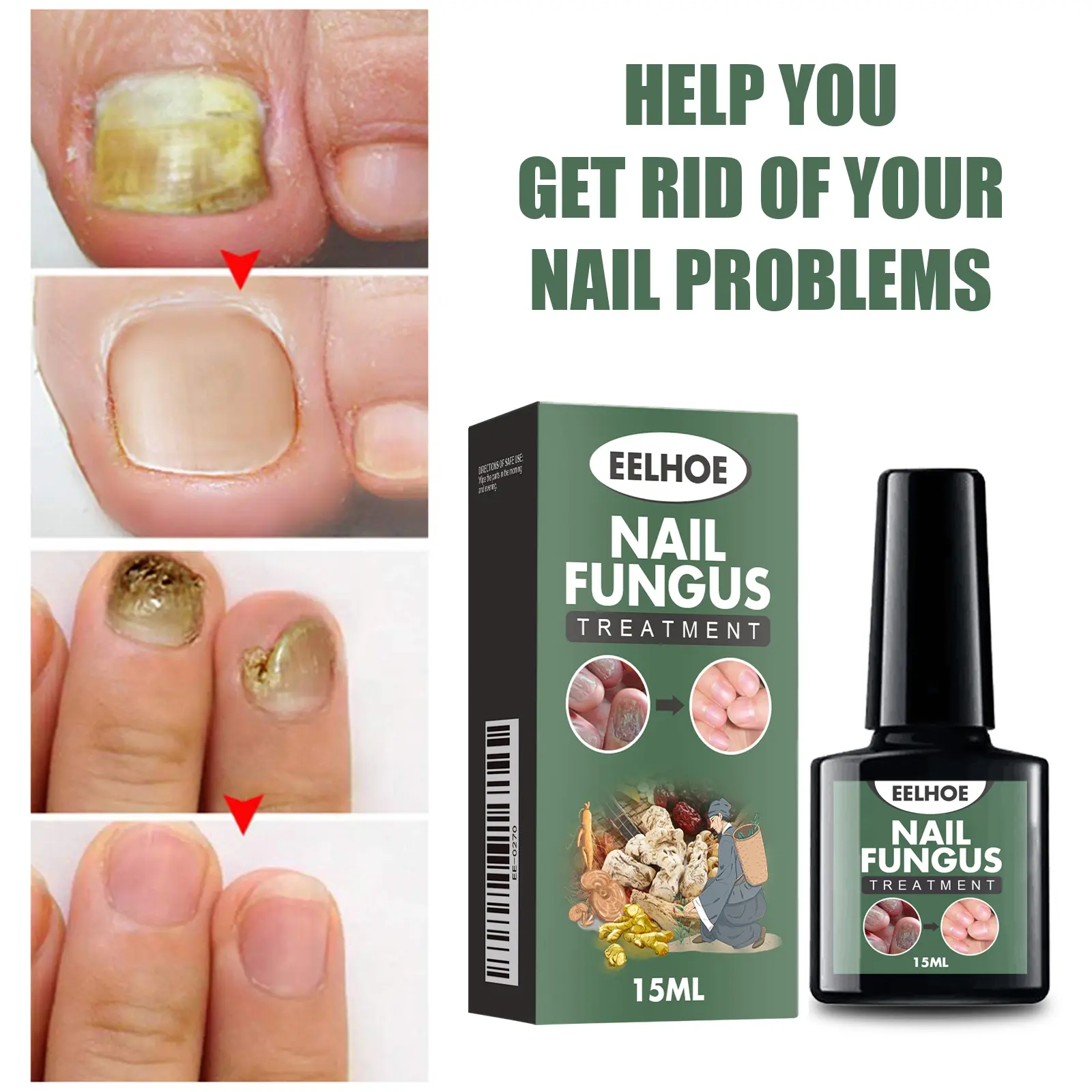 EELHOE Perawatan Onikomikosis Tangan & Kaki 15ML - Solusi Perbaikan Penebalan Kuku & Pelembut Kuku Mengandung Asam Salisilat Glycerin & Allantoin untuk Menghilangkan Masalah Kuku Nail