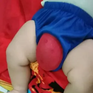 Celana Sunat Bayi Celana Khitan Bayi