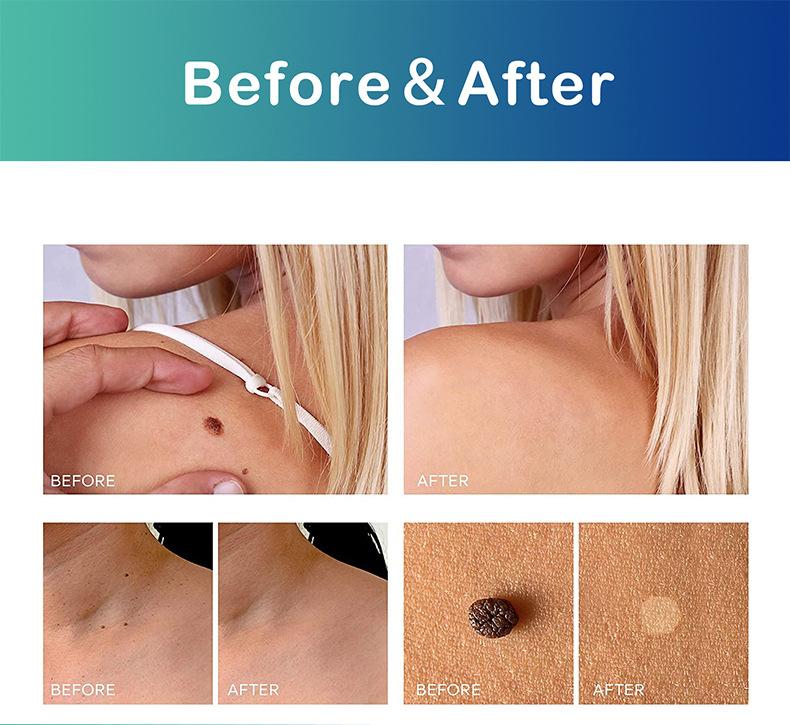 Product Introduction of [in Stock Now Released] Skin Tag Remover Mole Remover Cream Wart Removal Solution Spot Removal No Pit Mole Removal Wart Removal Water Acne Skincare Skin Repair 5