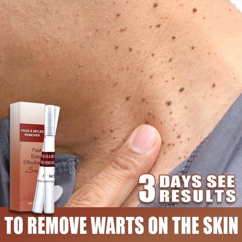 Product Introduction of Warts Remover Cream Original Watson Warts Removal Mole Remover Organic Cream Skin Tags and Warts Remover Original 2