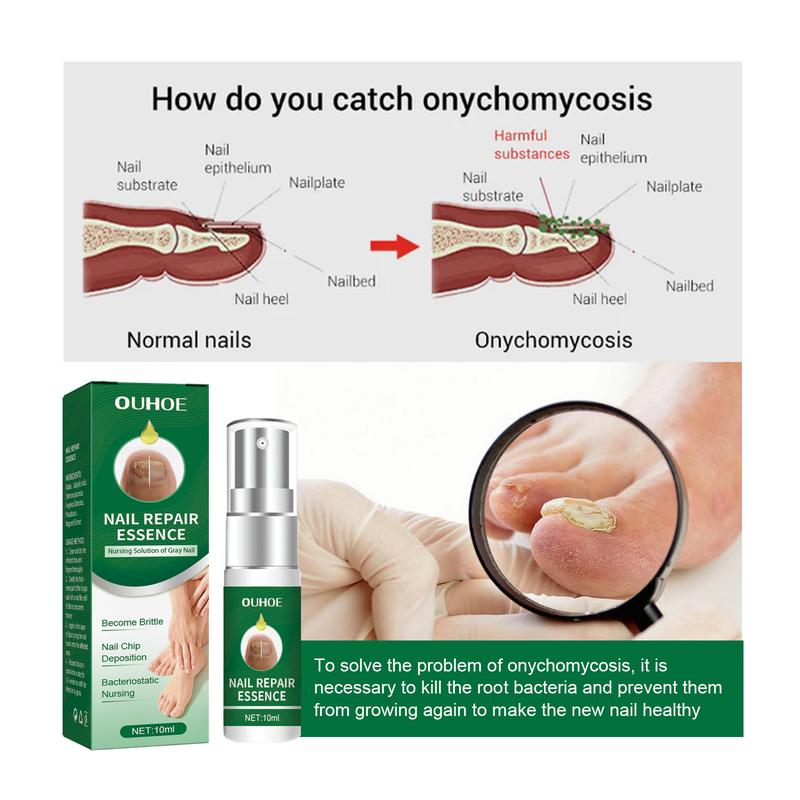 Product Introduction of 100% Original Brand Ouhoe Toenail Repair Essence Gray Nail Soft Yellow Thickening Inlay Bright Manicure Comfort 3