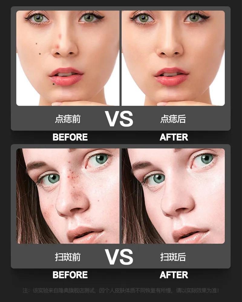 Product Introduction of 9 levLCD Laser Plasma Pen Skin Care Dark Spot Mole Remover Facial Freckle Mole Tattoo Removal Machine Tag Wart Removal Pen 41