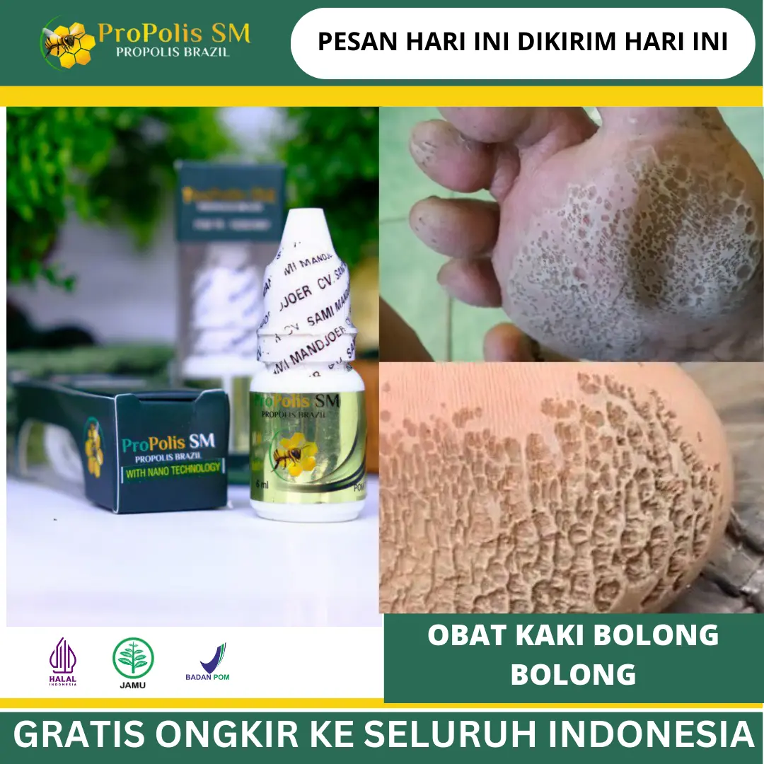Atasi Dengan Propolis Sm Penyakit Kaki Bolong Bolong, Rorombeheun, Rayapan, Retak, Pecah Pecah, Kapalan, Kaki Korodok, Telapak Kaki Berlubang Dan Bau, Penghilang Kaki Pecah Dan Kering, Kutu Air, Rangen