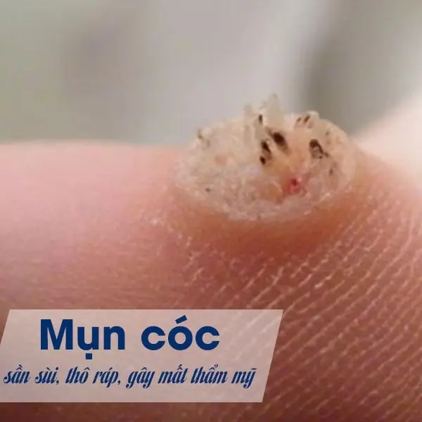Miếng dán mụn cóc Hiệu quả nhanh