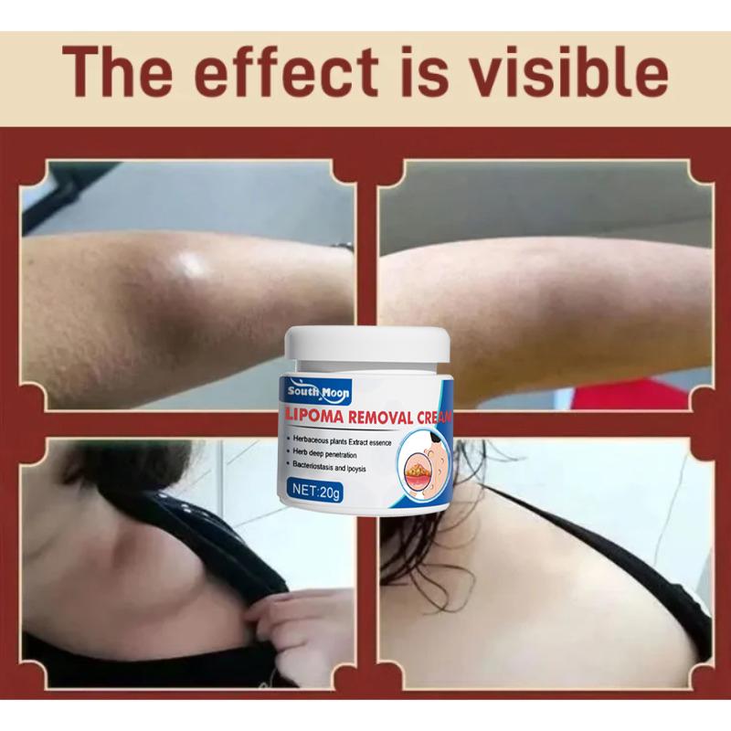 Krim Perbaikan Benjolan Lemak, Benjolan Keras, Benjolan Subkutan, Lipoma, Salep Benjolan, Krim Penghapus Lipoma, Secara Khusus Menghilangkan Beberapa Benjolan Subkutan Tunggal, Krim Benjolan Kulit / Obat Benjolan Efektif