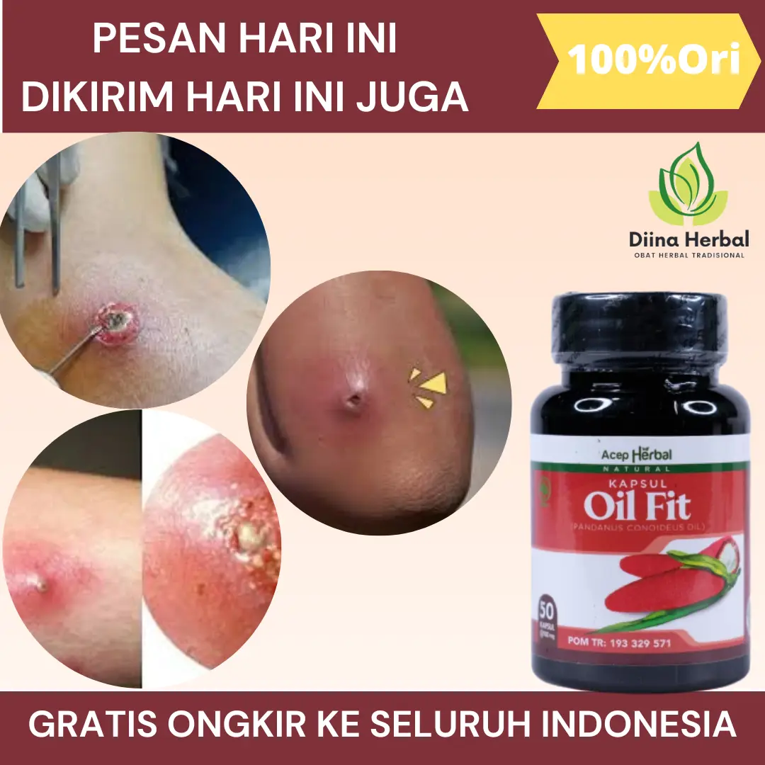 Bisulan Dipantat, Bisul Bernanah, Bisul Gak Tumbuh Lagi, Bisul Di Kemaluan, Penghilang Bisul, Bisul Telur Kodok