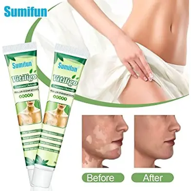 Obat Penghilang Vitiligo Salep Krim Vitiligo Kulit Bercak Belang Bintik Putih Paling Ampuh 20 gr Bebas Paraben 4