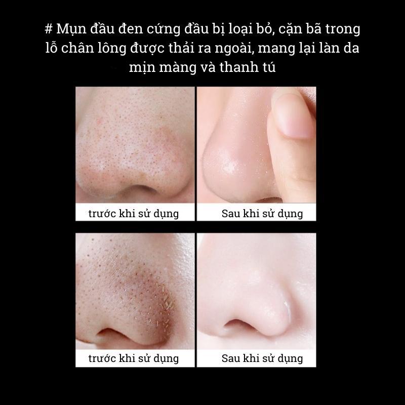 Product Introduction of Gel lột mụn đầu đen mụn cám than tre hoạt tính, gel lột hút mụn đầu đen hiệu quả giúp se khít lỗ chân lông 19