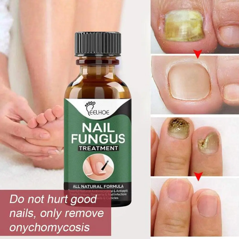 Cairan Perbaikan Kuku Dan Kuku Kaki 30ml Antibakteri Antijamur Infeksi Lembut Menutrisi Mencerahkan Tangan Dan Kaki Onikomikosis Menebalkan Kerusakan Kuku Lembut Kesehatan Kuku Tidak Merusak Memperbaiki Kutikula Yang Berubah Warna Menghilangkan Bau