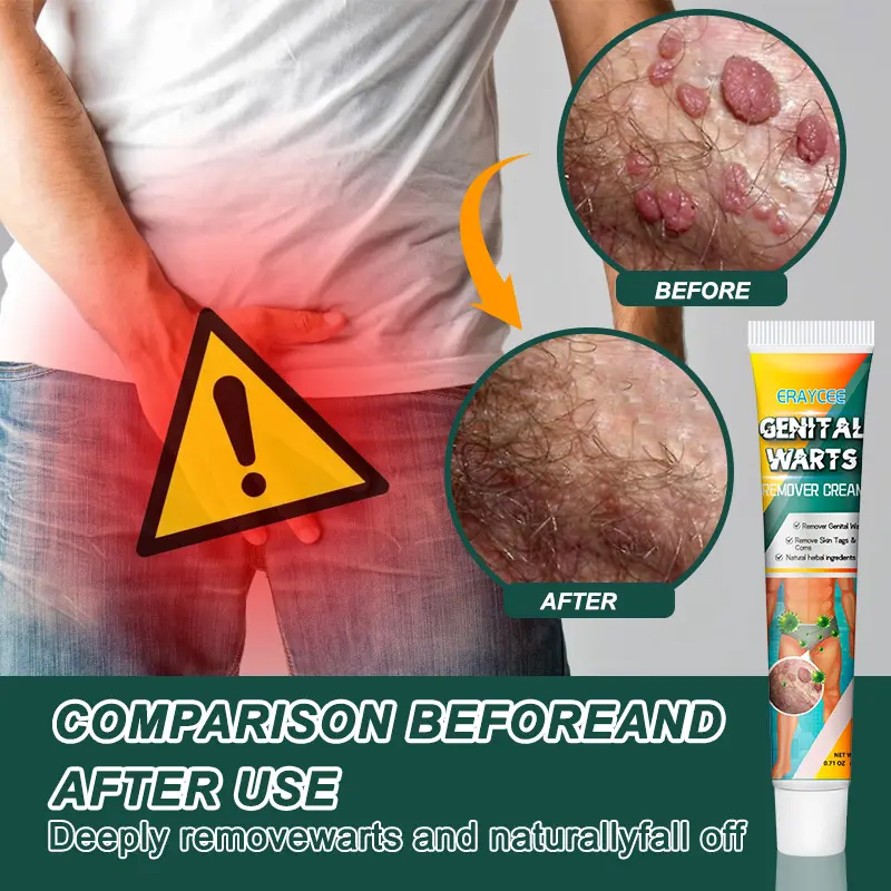 Kem Loại Bỏ Mụn Cóc Thảo Dược, Dành Cho Nam Và Nữ, Sử Dụng Trên Khu Vực Riêng Tư, Pinghou You, Hiệu Quả