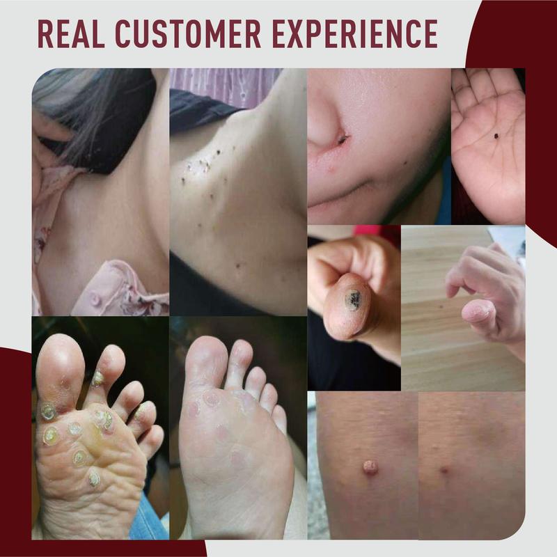 Product Introduction of Warts Remover Cream Original Watson Warts Removal Mole Remover Organic Cream Skin Tags and Warts Remover Original 3