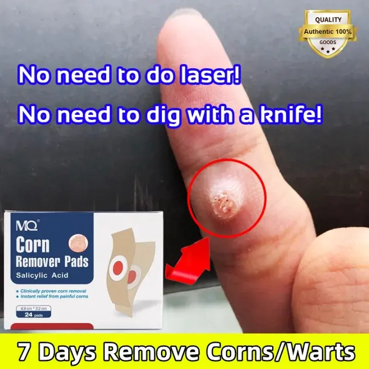 24PCS CORN REMOVAL PATCH - Koyo Kaki Ampuh Plester Penghilang Kutil Kapalan Mata Ikan Kapalan Corn Patch Removal Obat Kutil Kapalan Mata Ikan Kaki/Plester Penghilang Kutil Mata Ikan 3