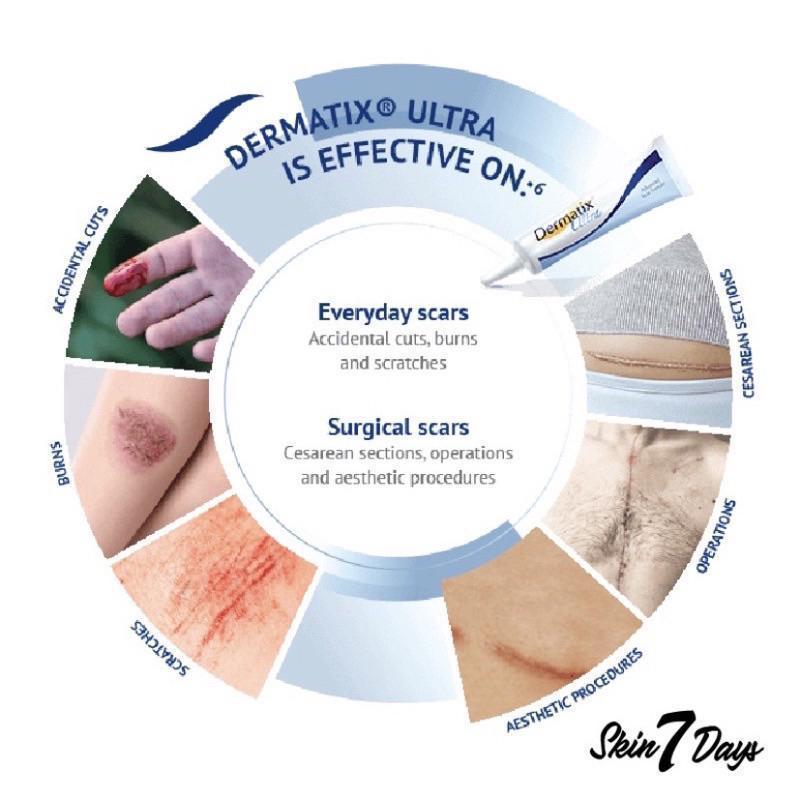 Product Introduction of COD Dermatix dermatix penghilang bekas luka  Apotik  15gel Krim Penghilang Bekas Luka Origina 3