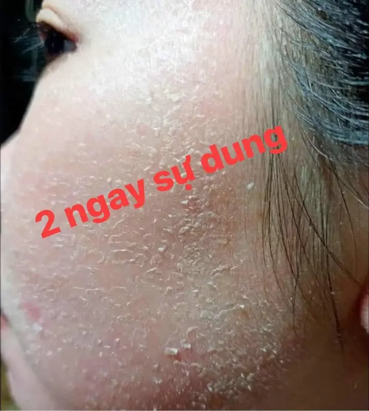 Serum Tái Tạo Siêu Tốc Cổ Mộc Lan Peel Da Bóc Tách Nám Tàn Nhang 50ml Skincare Làm Đẹp Da 2